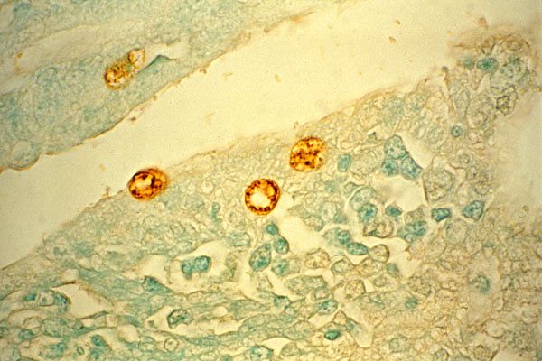 คลามีเดีย ทราโคมาติส (chlamydia trachomatis)