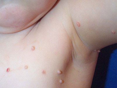 ภาพถ่ายของ Molluscum contagiosum