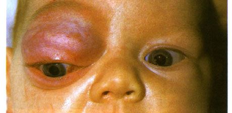Caparinal hemangioma ส่วนก่อนหน้าของวงโคจรและเปลือกตาบน  ความกระปรี้กระเปร่ามีแนวโน้มที่จะก้าวหน้า