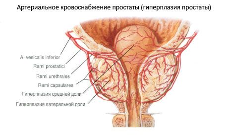 tub de prostatita introdus trus prostate volume calculation