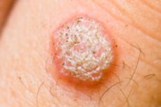 Infectia cu HPV: Cauze, simptome, tratament, preventie | Bioclinica