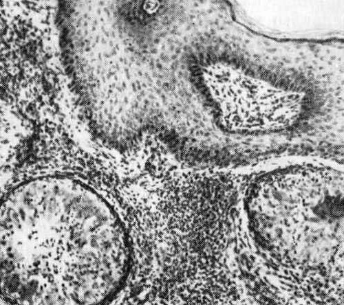 โรคติดเชื้อ chromoblastomycosis